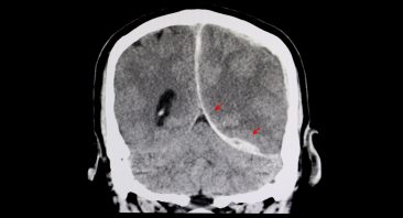 CT scan of a brain of a patient with interhemispheric hemorrhage from trauamatic brain injury (TBI).