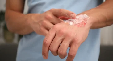 A person applies appointment to a burn on their hand; they most likely need a Birmingham burn injury attorney.