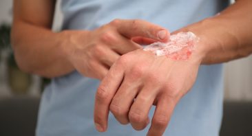 A person applies medicine to a burn, illustrating they made need a Birmingham burn injury attorney.